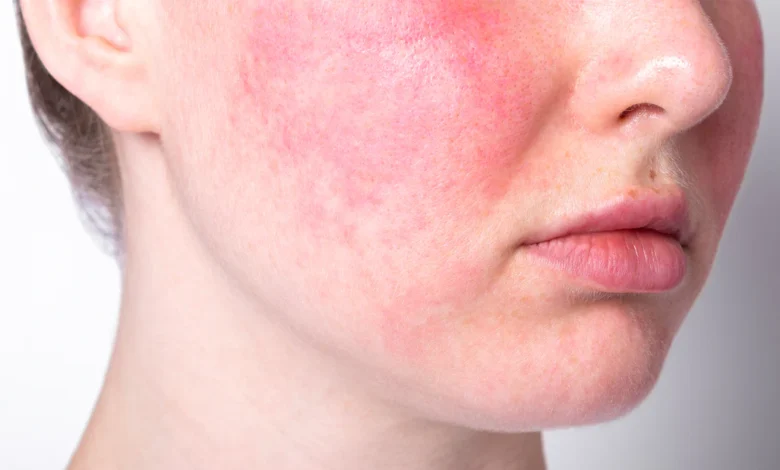 Rosacea Homeopathic Treatments