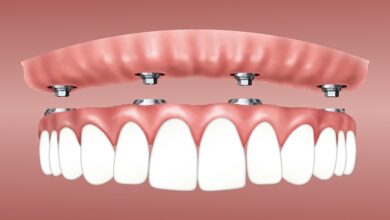 Affordable Dentures and Implants